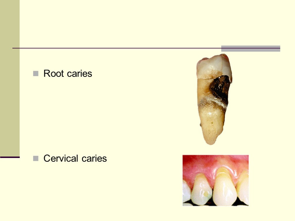 Root caries Cervical caries